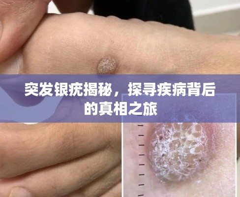 突发银疣揭秘，探寻疾病背后的真相之旅